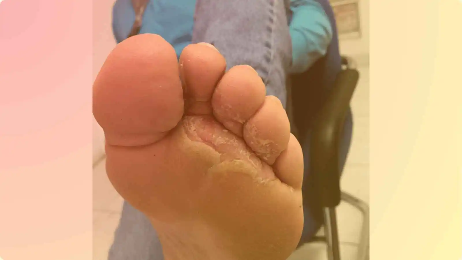 Diabetic Foot